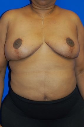 Breast Reduction
