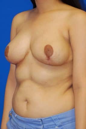 Breast Reduction