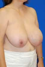 Breast Reduction
