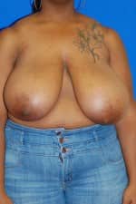 Breast Reduction