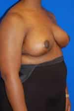 Breast Reduction