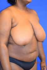 Breast Reduction