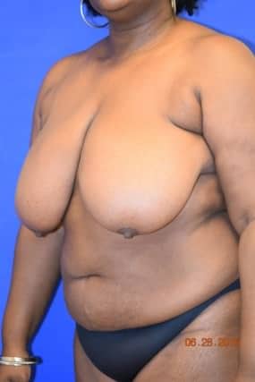 Breast Reduction