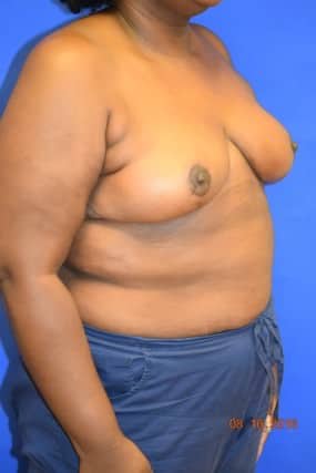 Breast Reduction