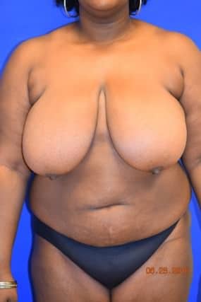 Breast Reduction
