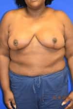 Breast Reduction