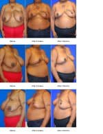 Breast Reduction