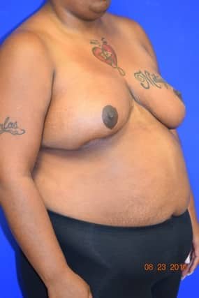 Breast Reduction