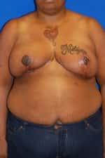 Breast Reduction