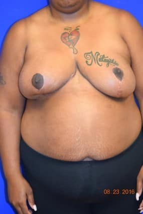Breast Reduction