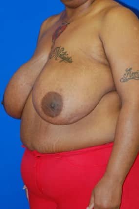 Breast Reduction
