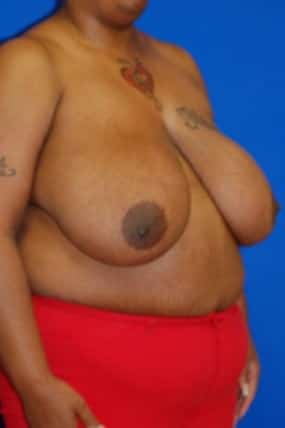 Breast Reduction