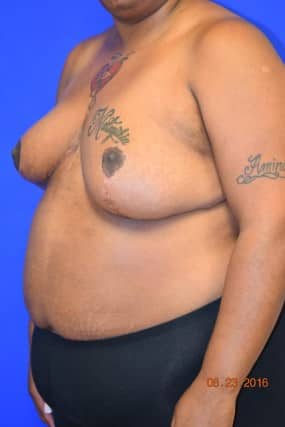 Breast Reduction