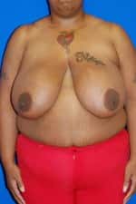Breast Reduction
