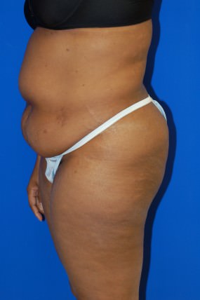 Liposuction