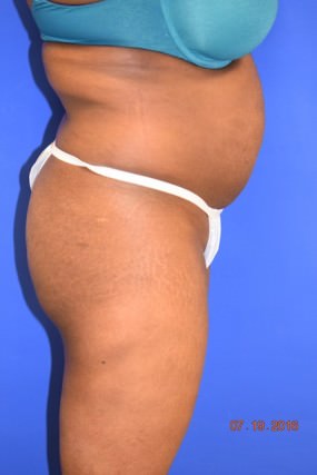 Liposuction