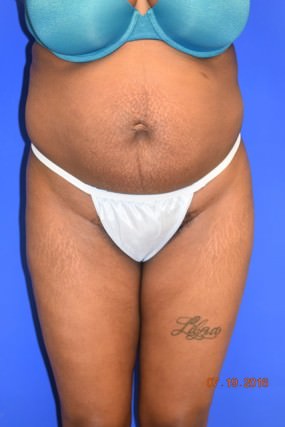 Liposuction