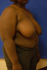 Breast Reconstruction