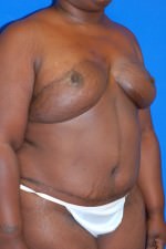 Breast Reconstruction