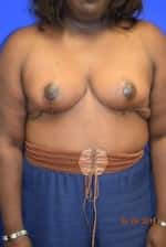 Breast Reduction