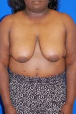 Breast Reduction