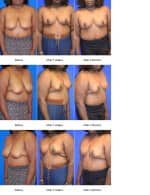 Breast Reduction