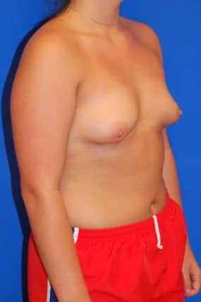 Breast Augmentation