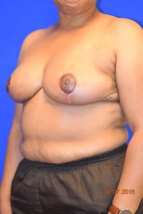 Breast Reduction