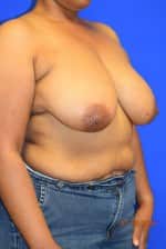 Breast Reduction