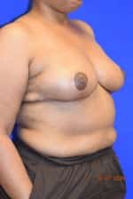 Breast Reduction