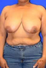 Breast Reduction