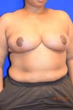 Breast Reduction
