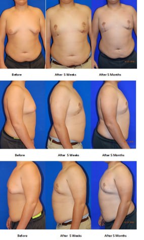 Male Breast Reduction