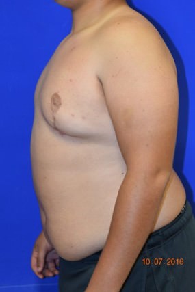 Male Breast Reduction