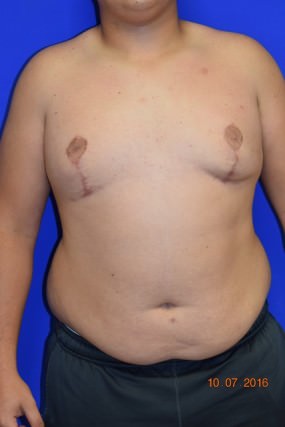 Male Breast Reduction