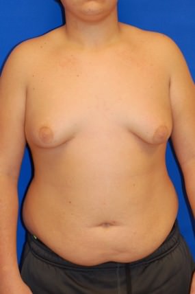 Male Breast Reduction