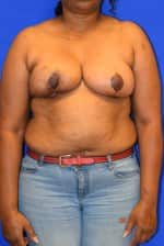 Breast Reduction