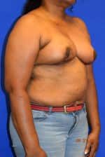 Breast Reduction