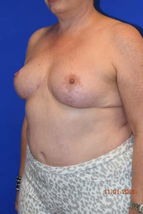 Breast Reduction