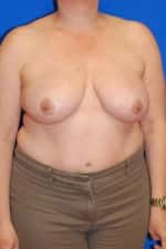 Breast Reduction