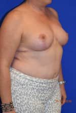 Breast Reduction