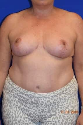 Breast Reduction