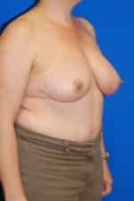 Breast Reduction