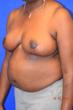Breast Reduction