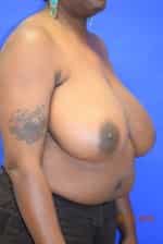 Breast Reduction