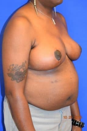Breast Reduction
