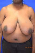 Breast Reduction