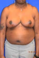 Breast Reduction