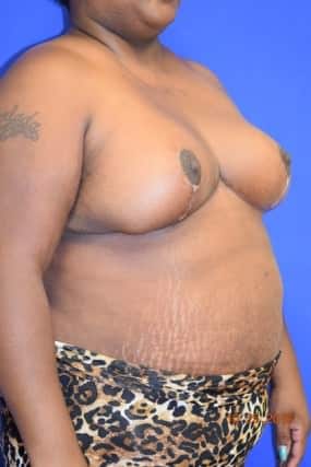 Breast Reduction