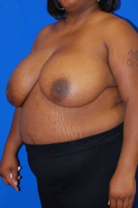 Breast Reduction